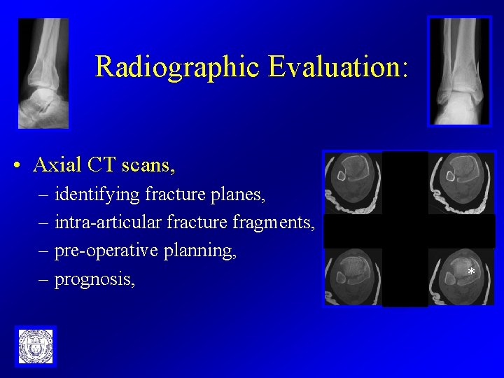 Radiographic Evaluation: • Axial CT scans, – identifying fracture planes, – intra-articular fracture fragments,