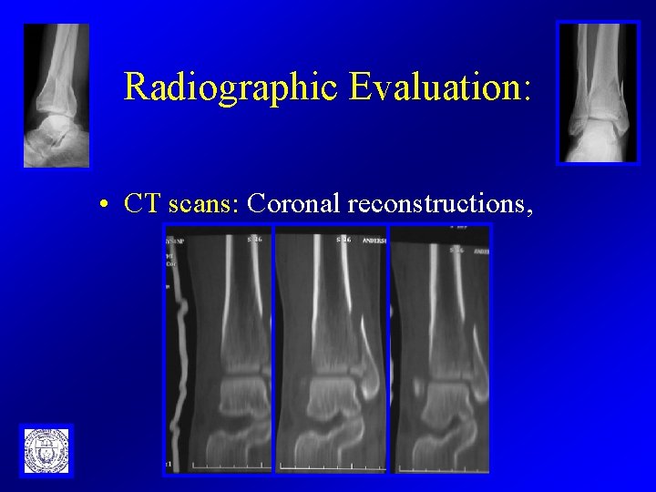 Radiographic Evaluation: • CT scans: Coronal reconstructions, 