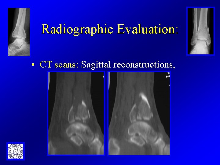 Radiographic Evaluation: • CT scans: Sagittal reconstructions, 