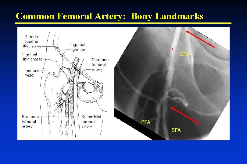 Common Femoral Artery: Bony Landmarks 