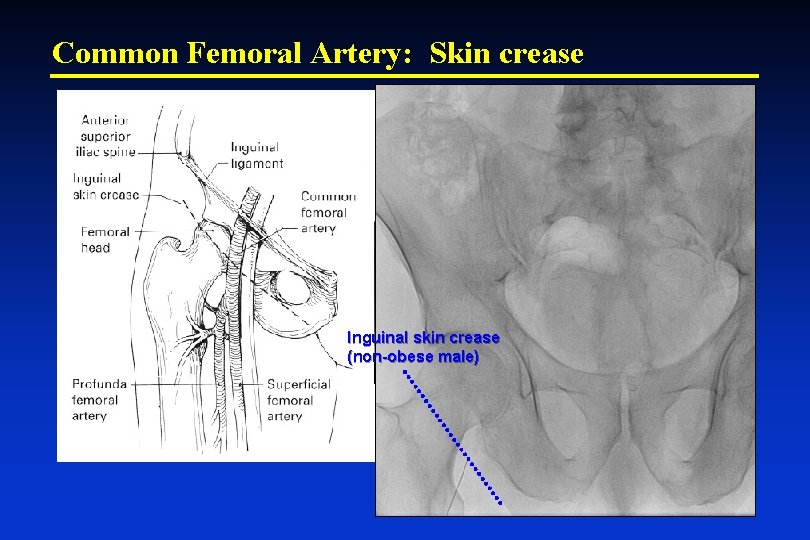 Common Femoral Artery: Skin crease Inguinal skin crease (non-obese male) 