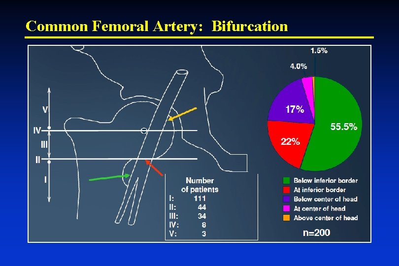 Common Femoral Artery: Bifurcation 