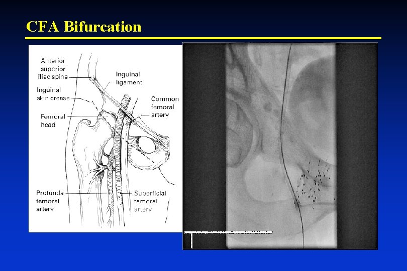 CFA Bifurcation 