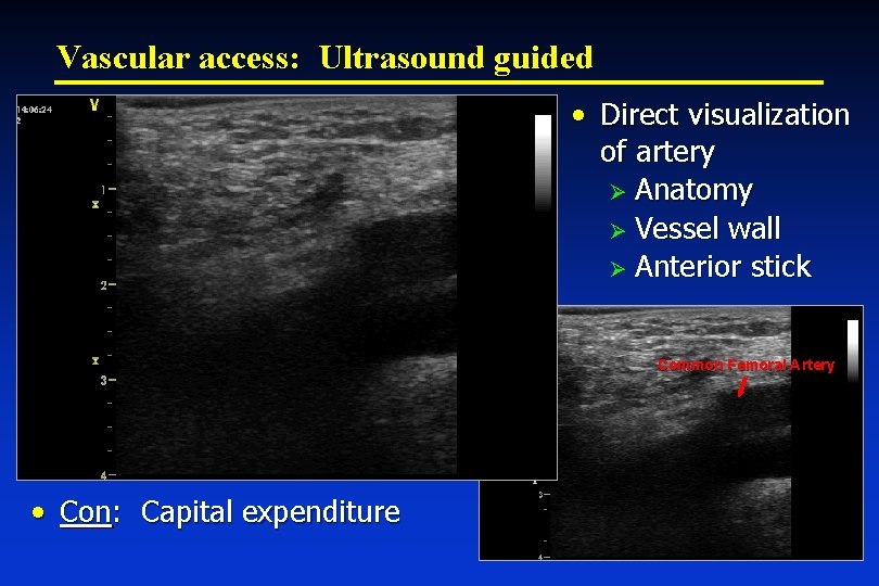 Vascular access: Ultrasound guided • Direct visualization of artery Ø Anatomy Ø Vessel wall
