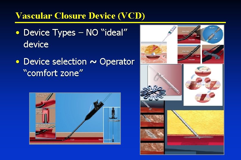 Vascular Closure Device (VCD) • Device Types – NO “ideal” device • Device selection