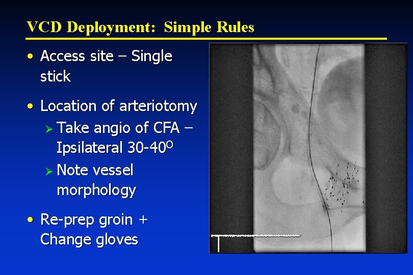 VCD Deployment: Simple Rules • Access site – Single stick • Location of arteriotomy