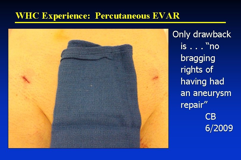 WHC Experience: Percutaneous EVAR Only drawback is. . . “no bragging rights of having