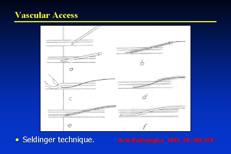 Vascular Access • Seldinger technique. Acta Radiologica 1953. 38: 368 -376. 