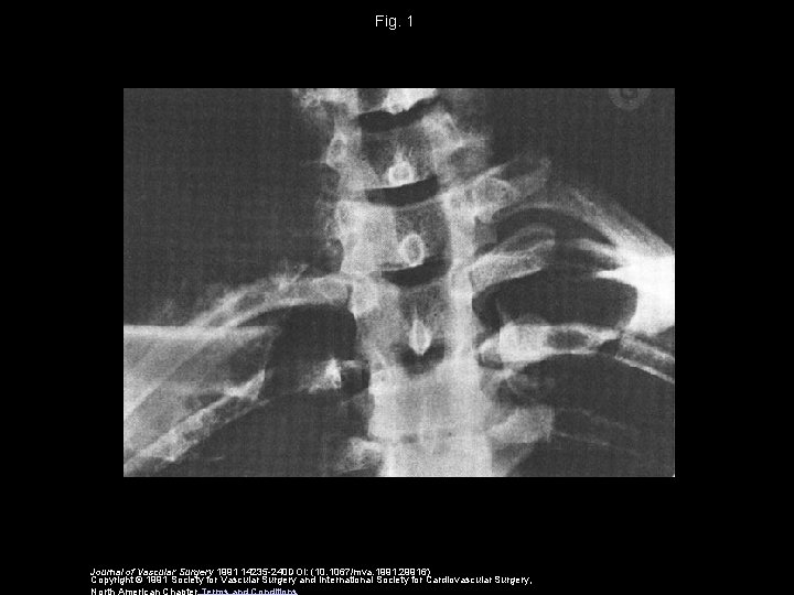 Fig. 1 Journal of Vascular Surgery 1991 14235 -240 DOI: (10. 1067/mva. 1991. 29916)