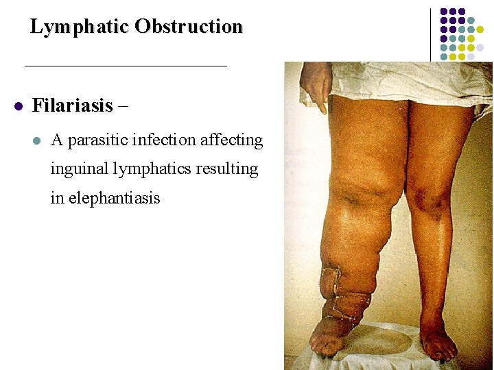 Lymphatic Obstruction l Filariasis – l A parasitic infection affecting inguinal lymphatics resulting in