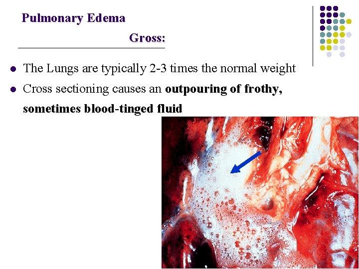 Pulmonary Edema Gross: l The Lungs are typically 2 -3 times the normal weight