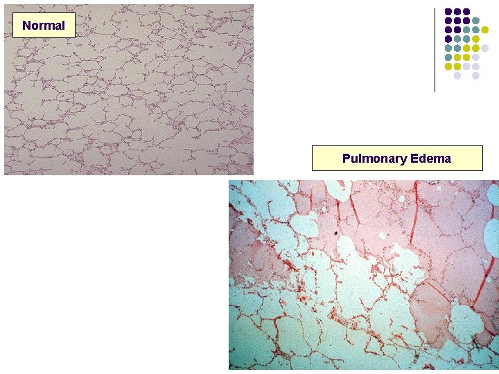 Normal Pulmonary Edema 