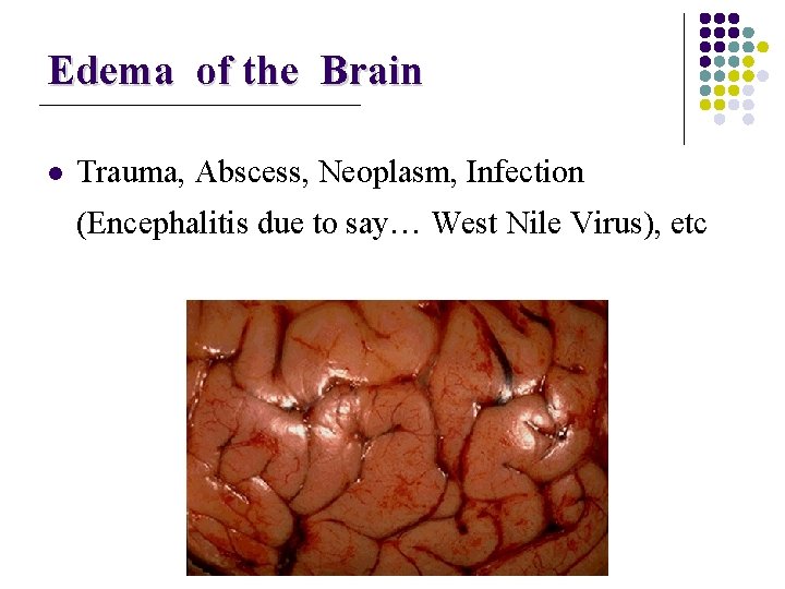 Edema of the Brain l Trauma, Abscess, Neoplasm, Infection (Encephalitis due to say… West
