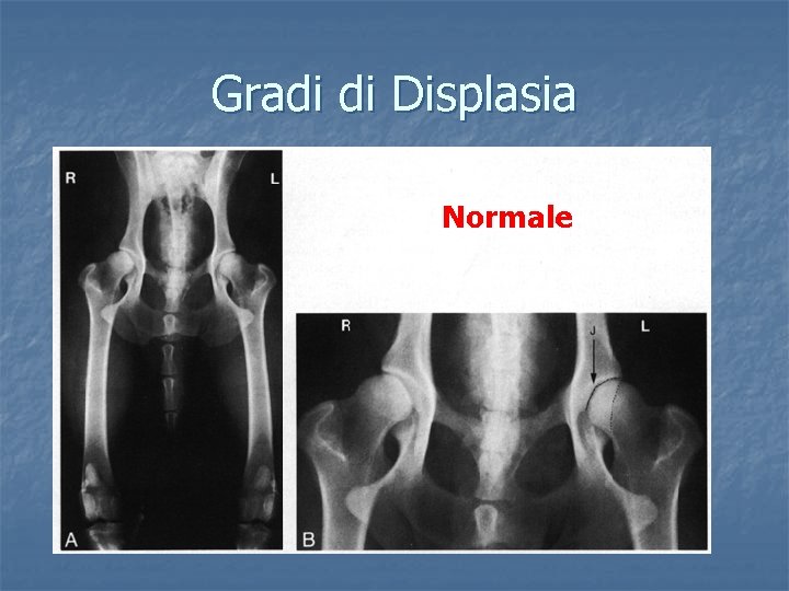 Gradi di Displasia Normale 