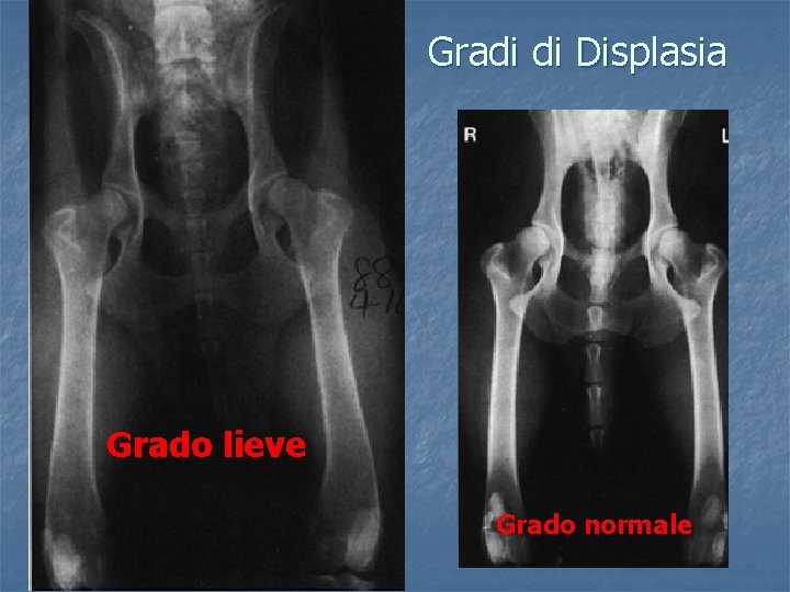 Gradi di Displasia Grado lieve Grado normale 