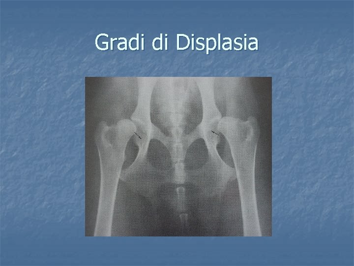 Gradi di Displasia 