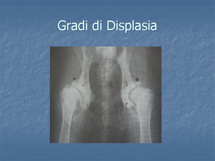 Gradi di Displasia 