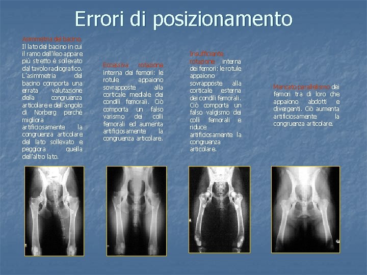 Errori di posizionamento Asimmetria del bacino. Il lato del bacino in cui il ramo