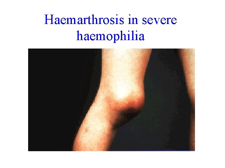 Haemarthrosis in severe haemophilia 