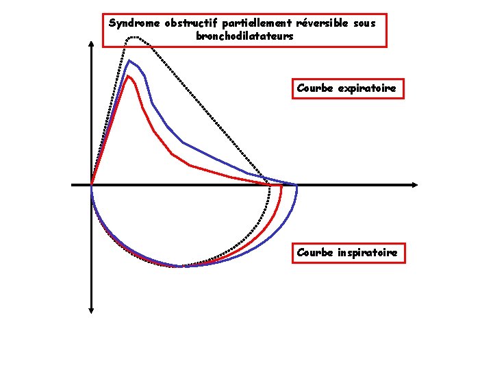 Syndrome obstructif partiellement réversible sous bronchodilatateurs Courbe expiratoire Courbe inspiratoire 