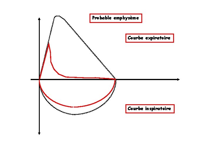 Probable emphysème Courbe expiratoire Courbe inspiratoire 