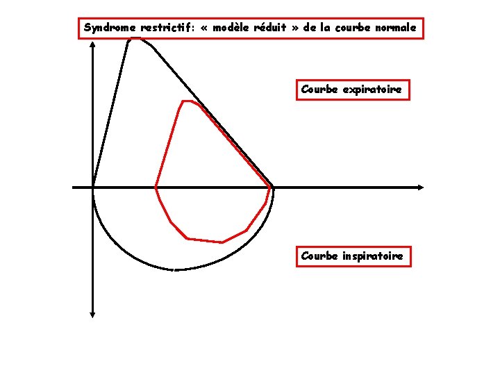 Syndrome restrictif: « modèle réduit » de la courbe normale Courbe expiratoire Courbe inspiratoire