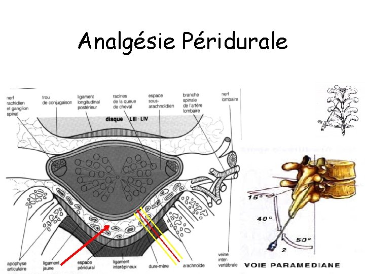 Analgésie Péridurale 