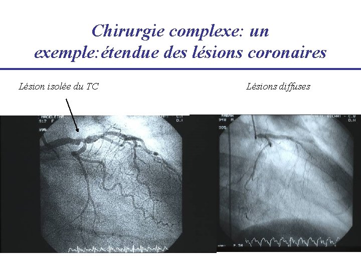Chirurgie complexe: un exemple: étendue des lésions coronaires Lésion isolée du TC Lésions diffuses