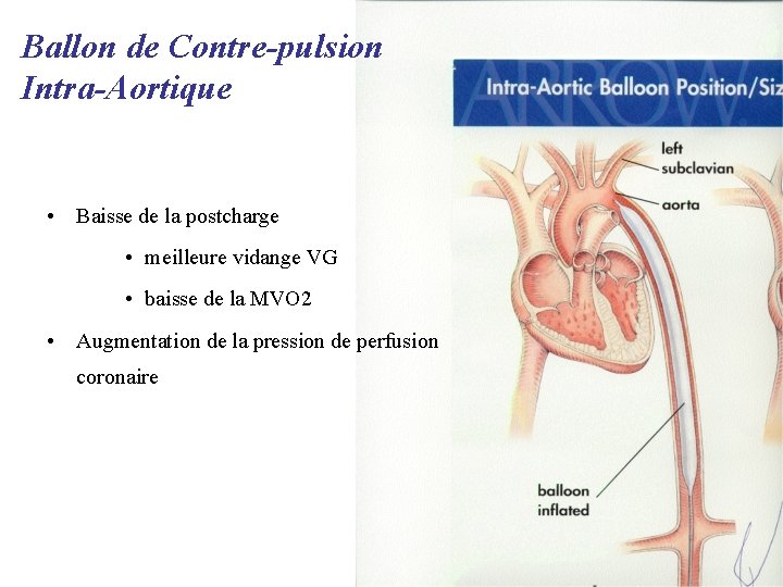 Ballon de Contre-pulsion Intra-Aortique • Baisse de la postcharge • meilleure vidange VG •