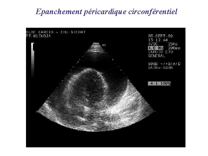 Epanchement péricardique circonférentiel 