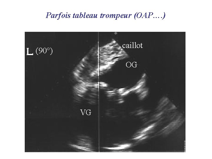 Parfois tableau trompeur (OAP…. ) caillot (90°) OG VG 