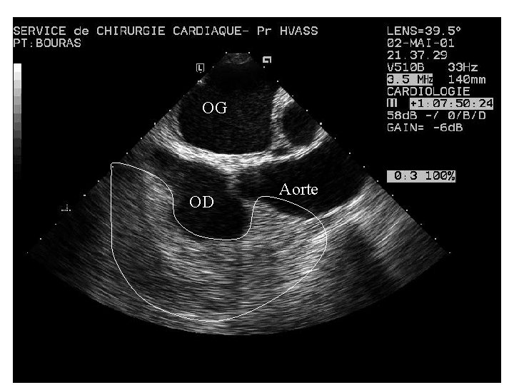 OG OD Aorte 