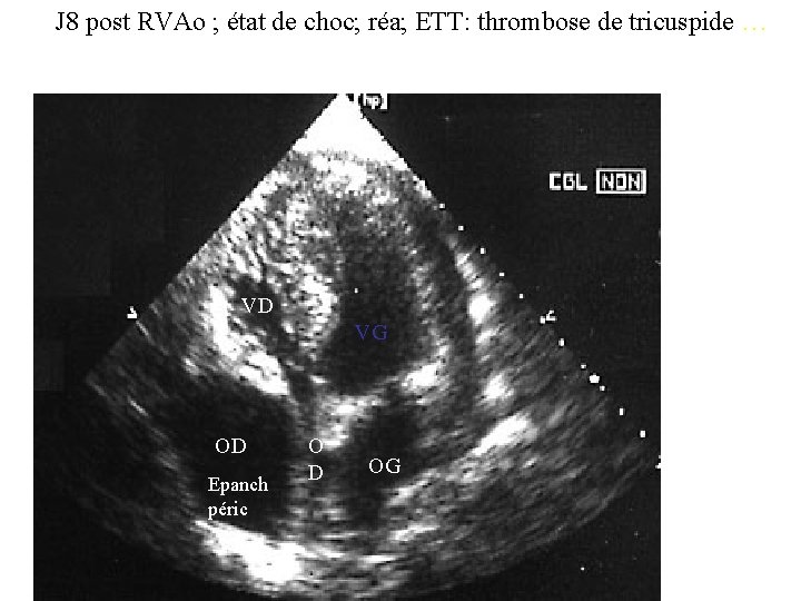 J 8 post RVAo ; état de choc; réa; ETT: thrombose de tricuspide …