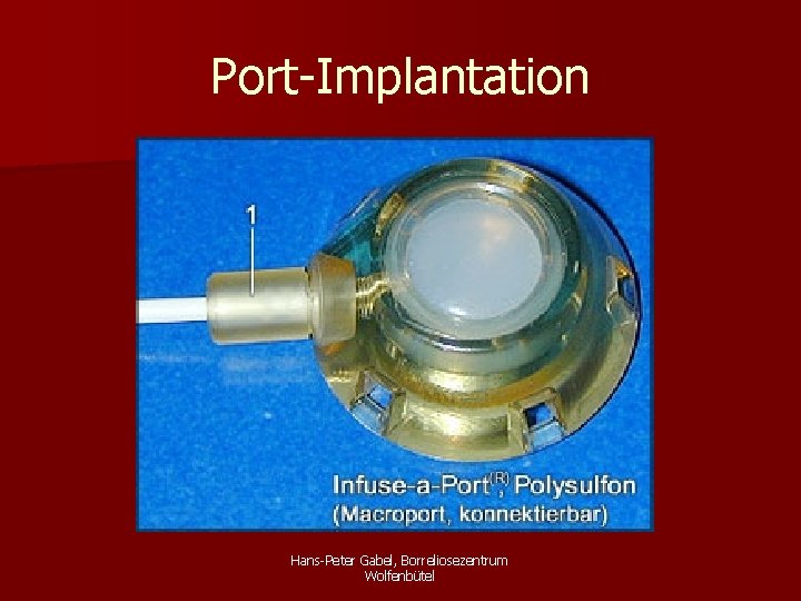 Port-Implantation Hans-Peter Gabel, Borreliosezentrum Wolfenbütel 