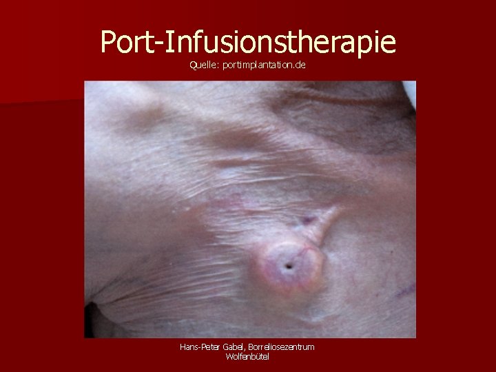 Port-Infusionstherapie Quelle: portimplantation. de Hans-Peter Gabel, Borreliosezentrum Wolfenbütel 