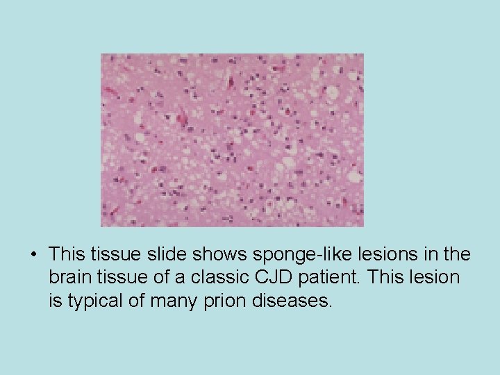  • This tissue slide shows sponge-like lesions in the brain tissue of a