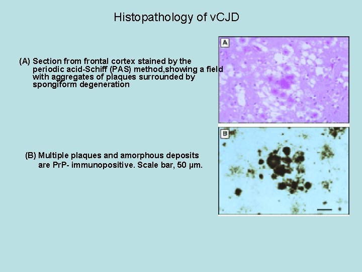 Histopathology of v. CJD (A) Section from frontal cortex stained by the periodic acid-Schiff