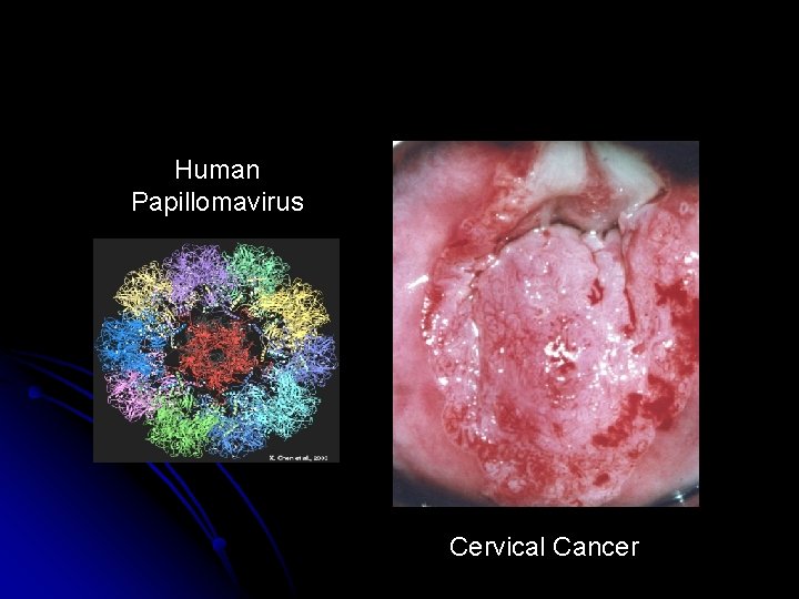 Human Papillomavirus Cervical Cancer 