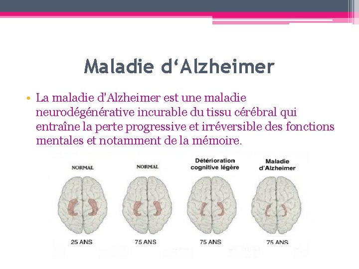 Maladie d‘Alzheimer • La maladie d'Alzheimer est une maladie neurodégénérative incurable du tissu cérébral