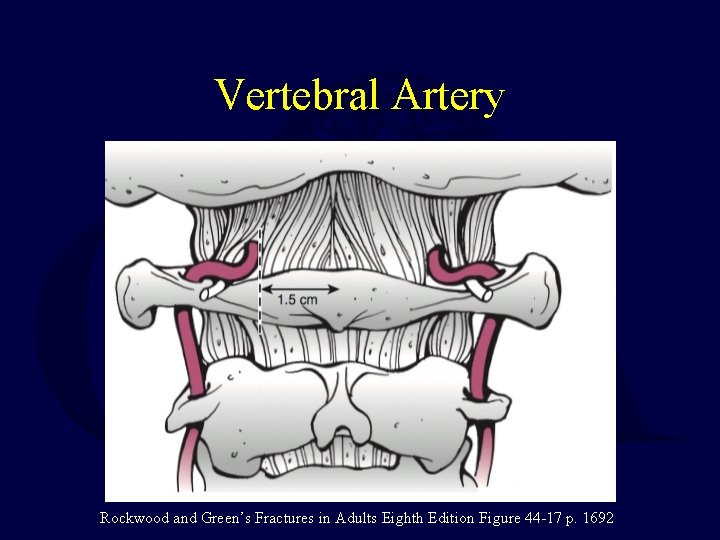 Vertebral Artery Rockwood and Green’s Fractures in Adults Eighth Edition Figure 44 -17 p.