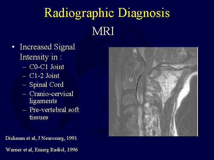Radiographic Diagnosis MRI • Increased Signal Intensity in : – – C 0 -C