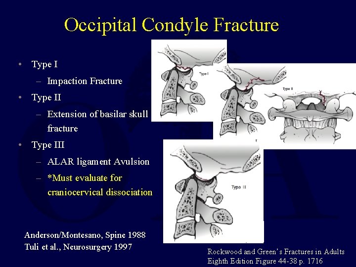 Occipital Condyle Fracture • Type I – Impaction Fracture • Type II – Extension