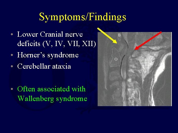 Symptoms/Findings • Lower Cranial nerve deficits (V, IV, VII, XII) • Horner’s syndrome •