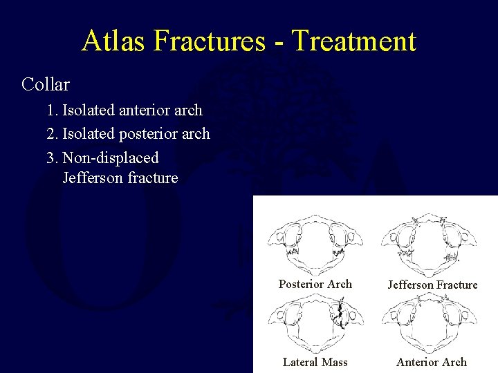 Atlas Fractures - Treatment Collar 1. Isolated anterior arch 2. Isolated posterior arch 3.