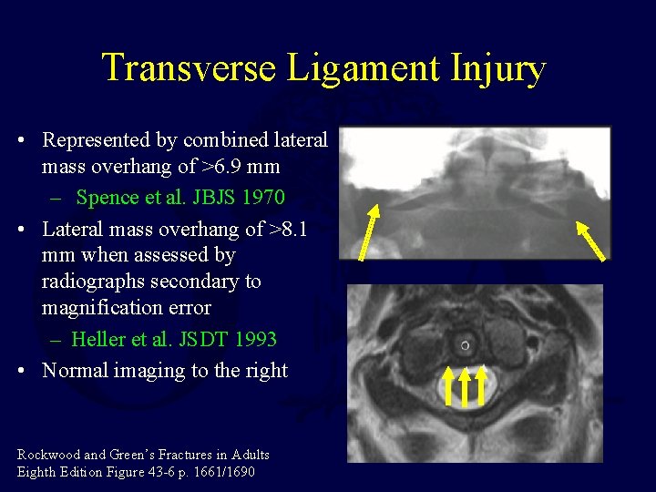 Transverse Ligament Injury • Represented by combined lateral mass overhang of >6. 9 mm