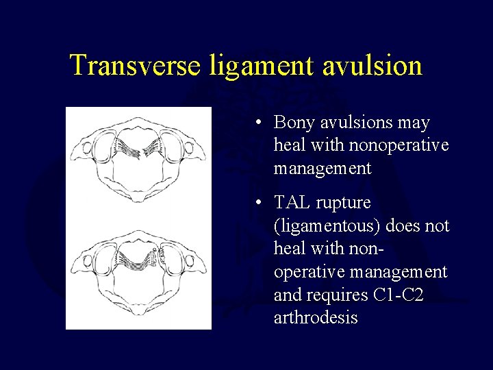 Transverse ligament avulsion • Bony avulsions may heal with nonoperative management • TAL rupture