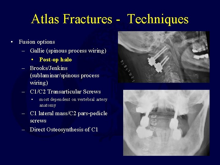 Atlas Fractures - Techniques • Fusion options – Gallie (spinous process wiring) • Post-op