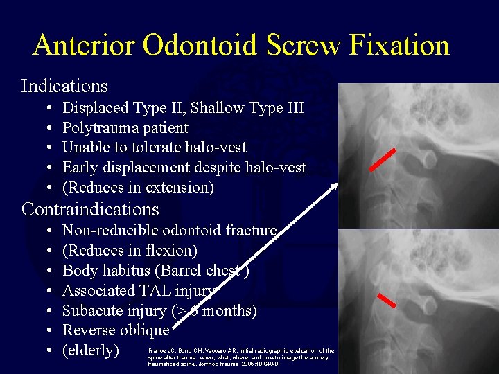 Anterior Odontoid Screw Fixation Indications • • • Displaced Type II, Shallow Type III