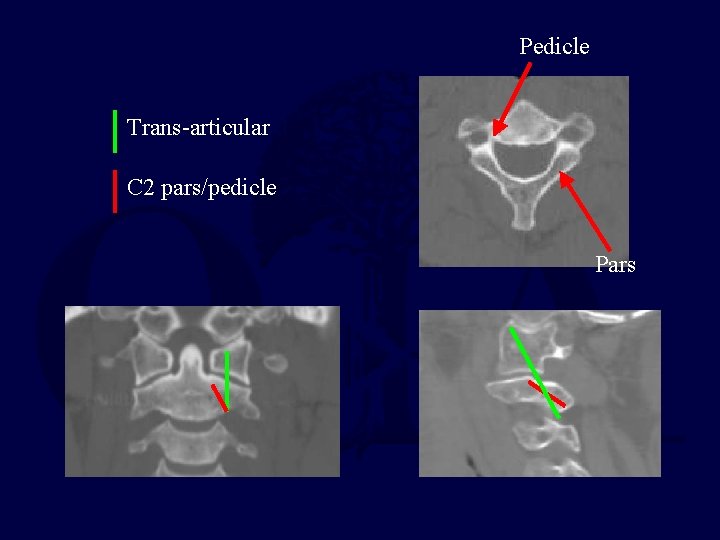 Pedicle Trans-articular C 2 pars/pedicle Pars 