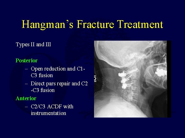 Hangman’s Fracture Treatment Types II and III Posterior – Open reduction and C 1